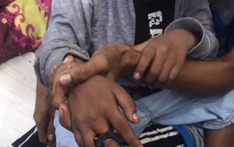 Nahas! Jari Tangan Seorang Anak Berusia 4 Tahun di Sampit Kejepit Kunci Gembok