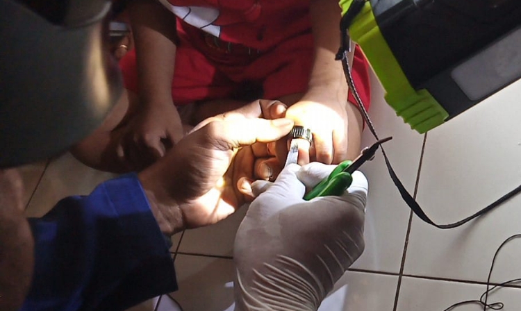 Jari Seorang Bocah di Sampit Terjepit Cincin Teropong Mainan Sampai Bengkak